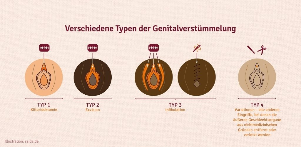 Typen der Genitalverstümmelung